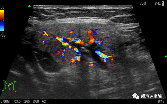 颌下腺导管结石的超声诊断