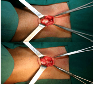 气管切开术的基本操作与重点技巧汇总