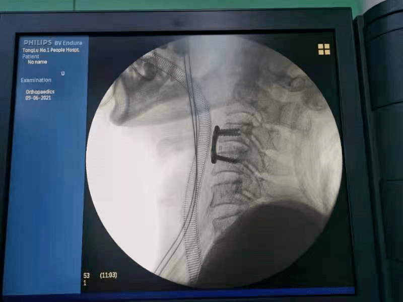 一院骨科成功开展县内首例自主完成的颈椎前路减压融合内固定术_手术