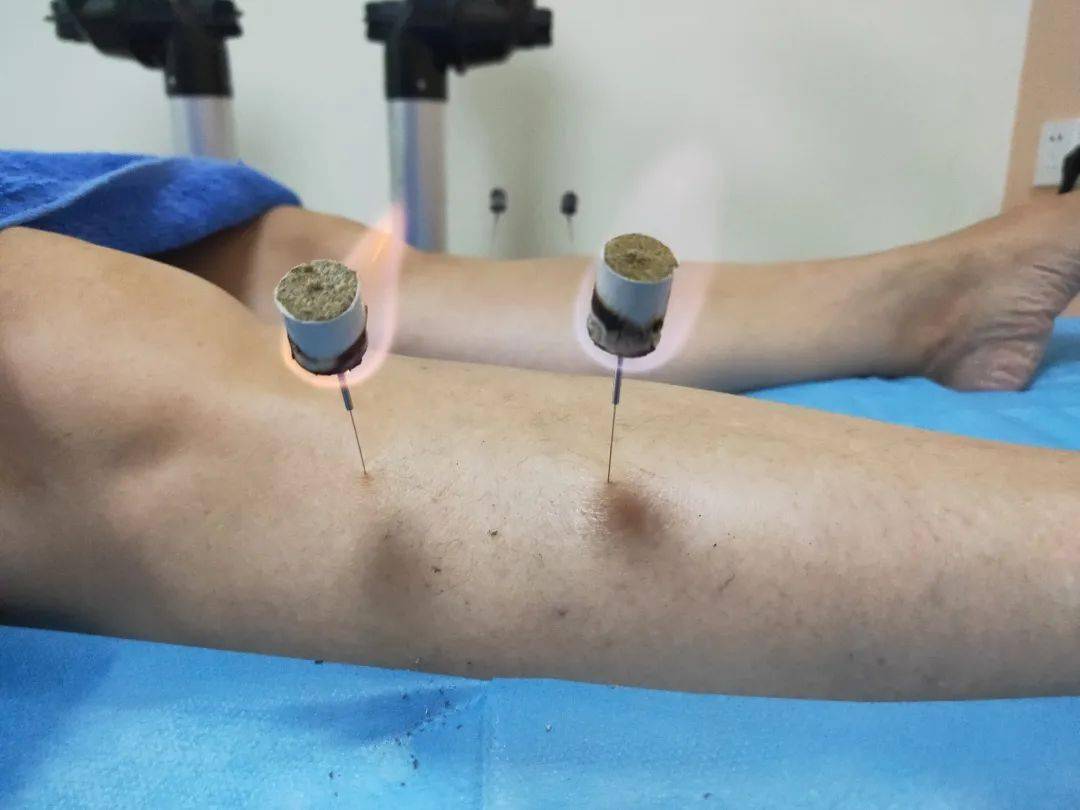 图温针灸疗法图拔罐疗法《黄帝内经》早有"春夏养阳,秋冬养阴"之说.