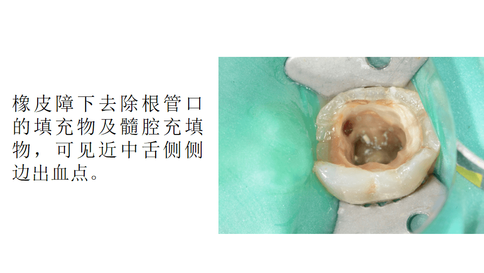 病例侧壁穿孔修补irootbpplus的应用