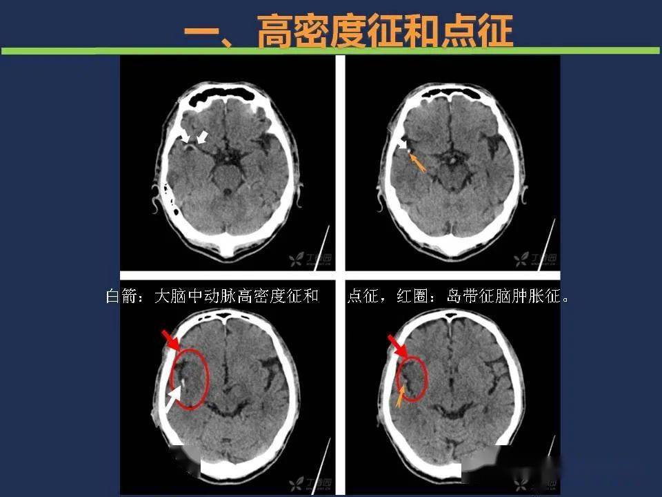 头颅ct如何预判超早期脑梗死