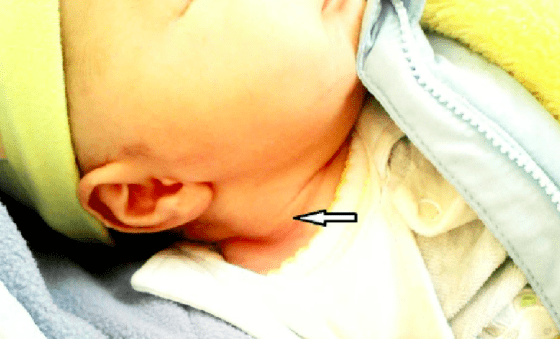 婴儿头左右不对称怎么办 0081c5f630654a65a800ade7e78c30d2.png