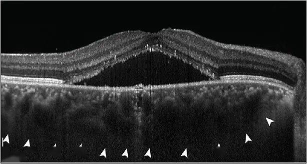 見微知著,oct圖像觀預後_視網膜