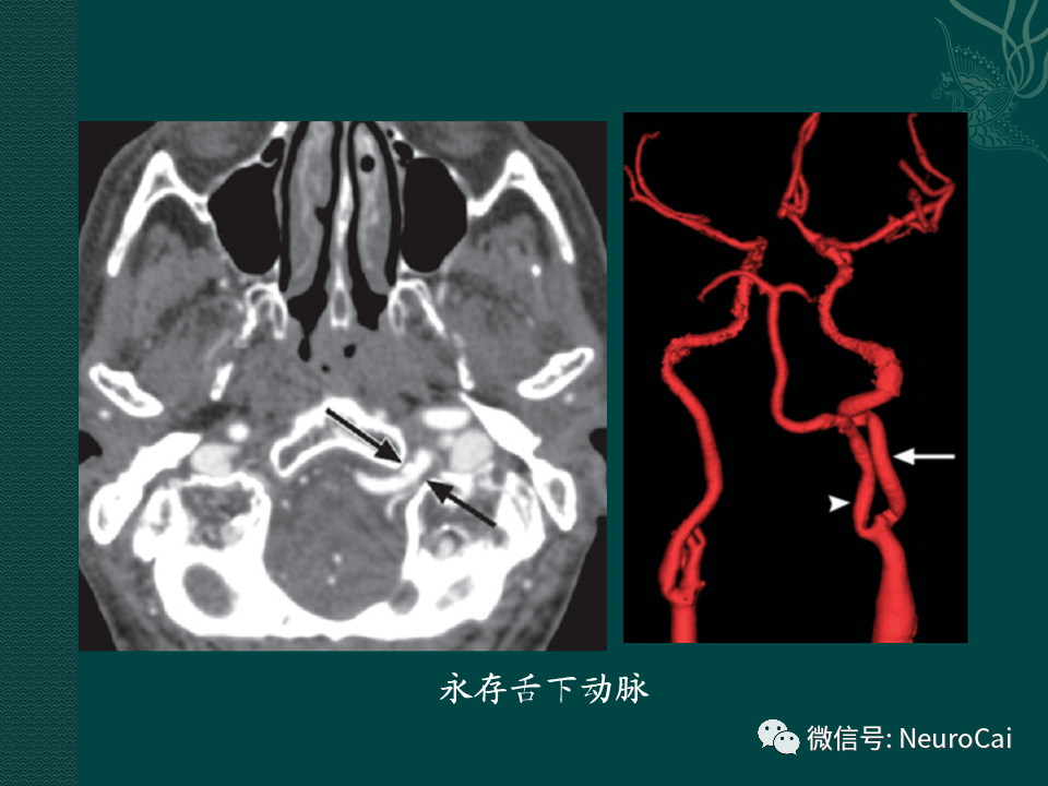 颈横血管解剖图CT图片