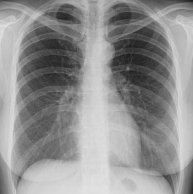肺部阴影x光片图片