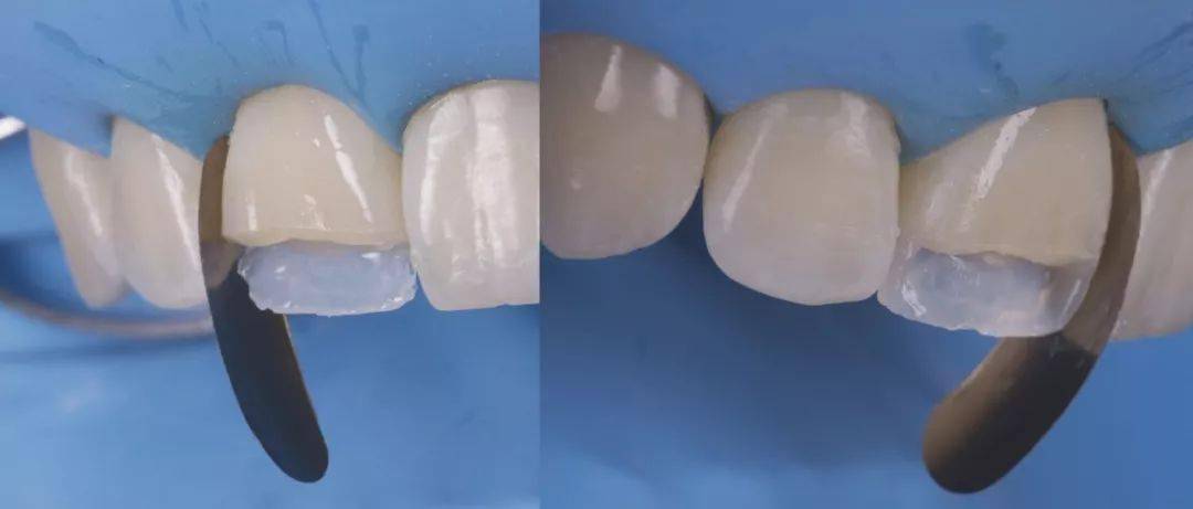 【病例分享】中切牙的修复:复合树脂直接修复vs全瓷贴面修复