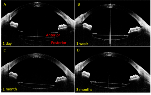 曲径通达慧眼明辨赵云娥教授解秘人工晶状体植入术后囊