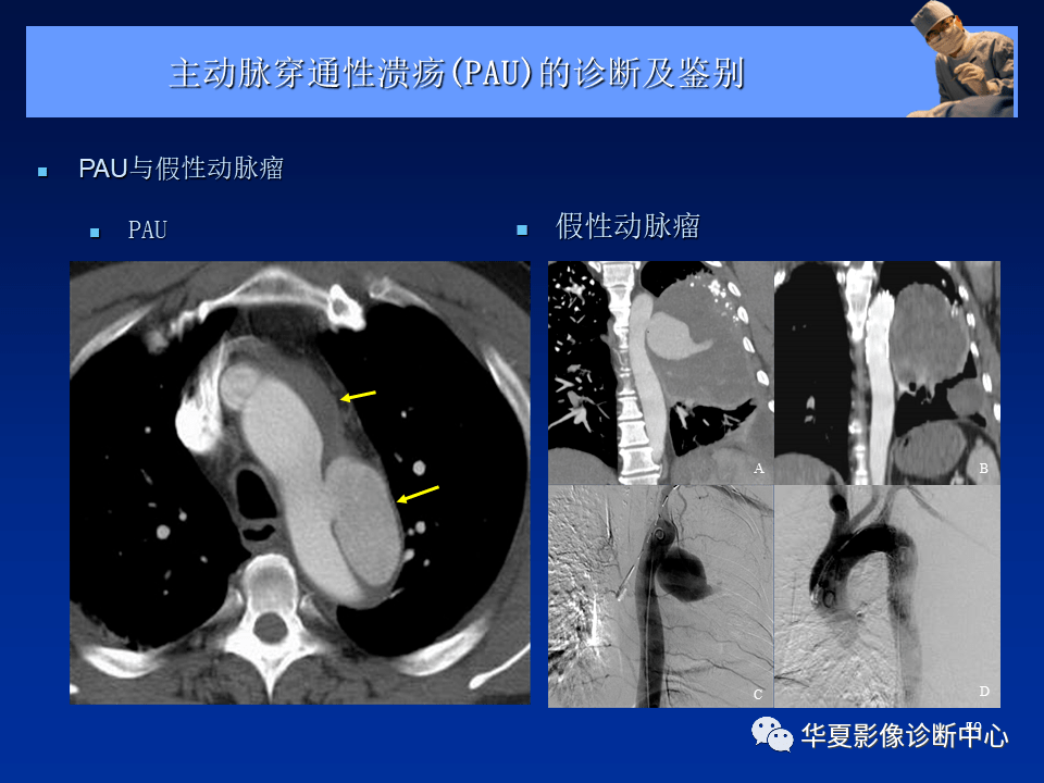 主动脉夹层,壁间血肿及穿通性溃疡