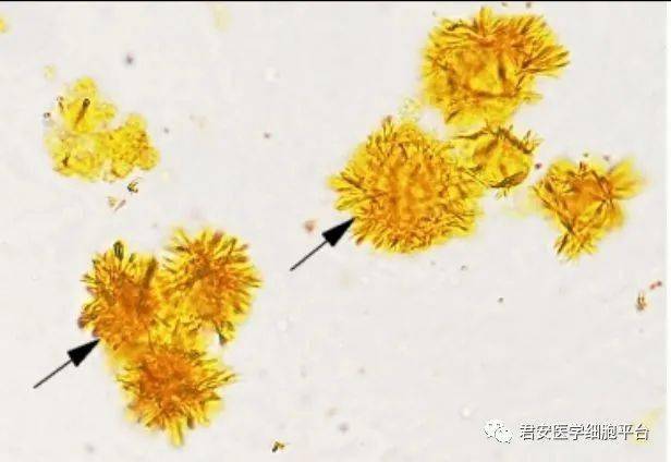 請報告箭頭所指有形成分的名稱2021309尿酸結晶點擊空白處查看答案請