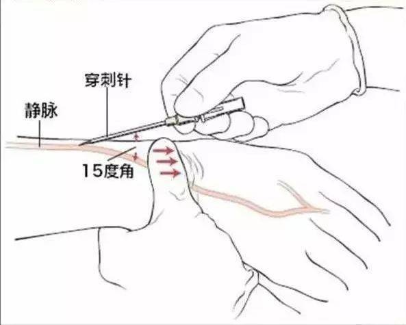 静脉穿刺角度试管和枕头颜色的秘密一张图帮你通过颜色辨识针头