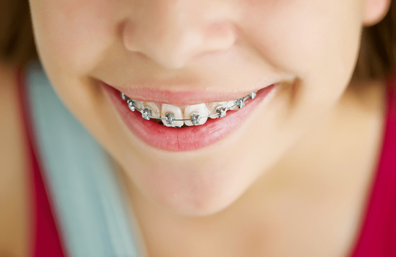 事半功倍的矫正黄金期——儿童早期牙齿矫正治疗