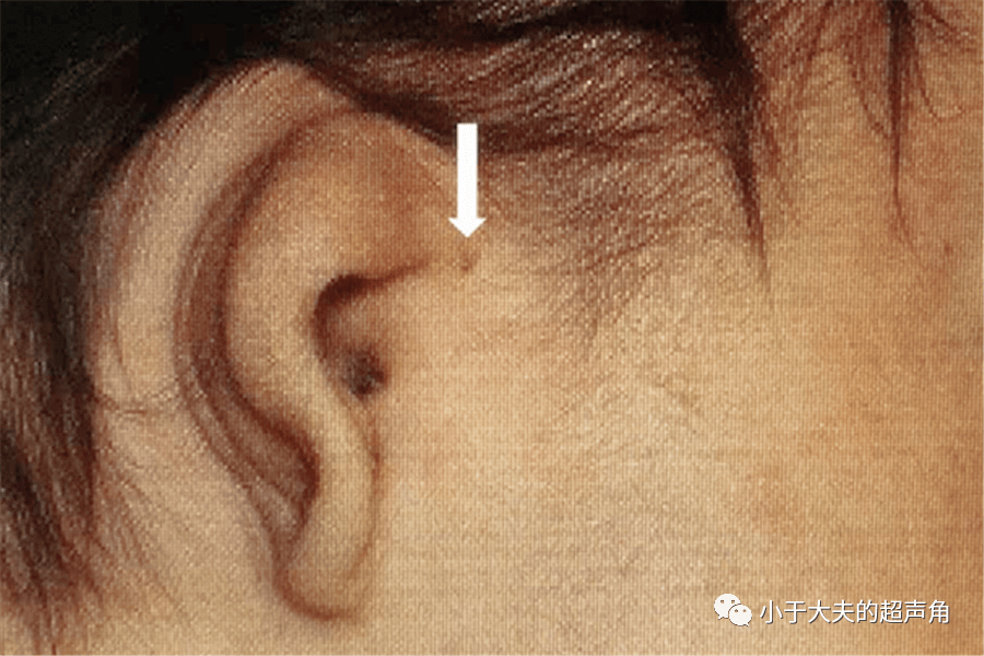 超声随响第82期先天性耳前瘘管进化的佐证
