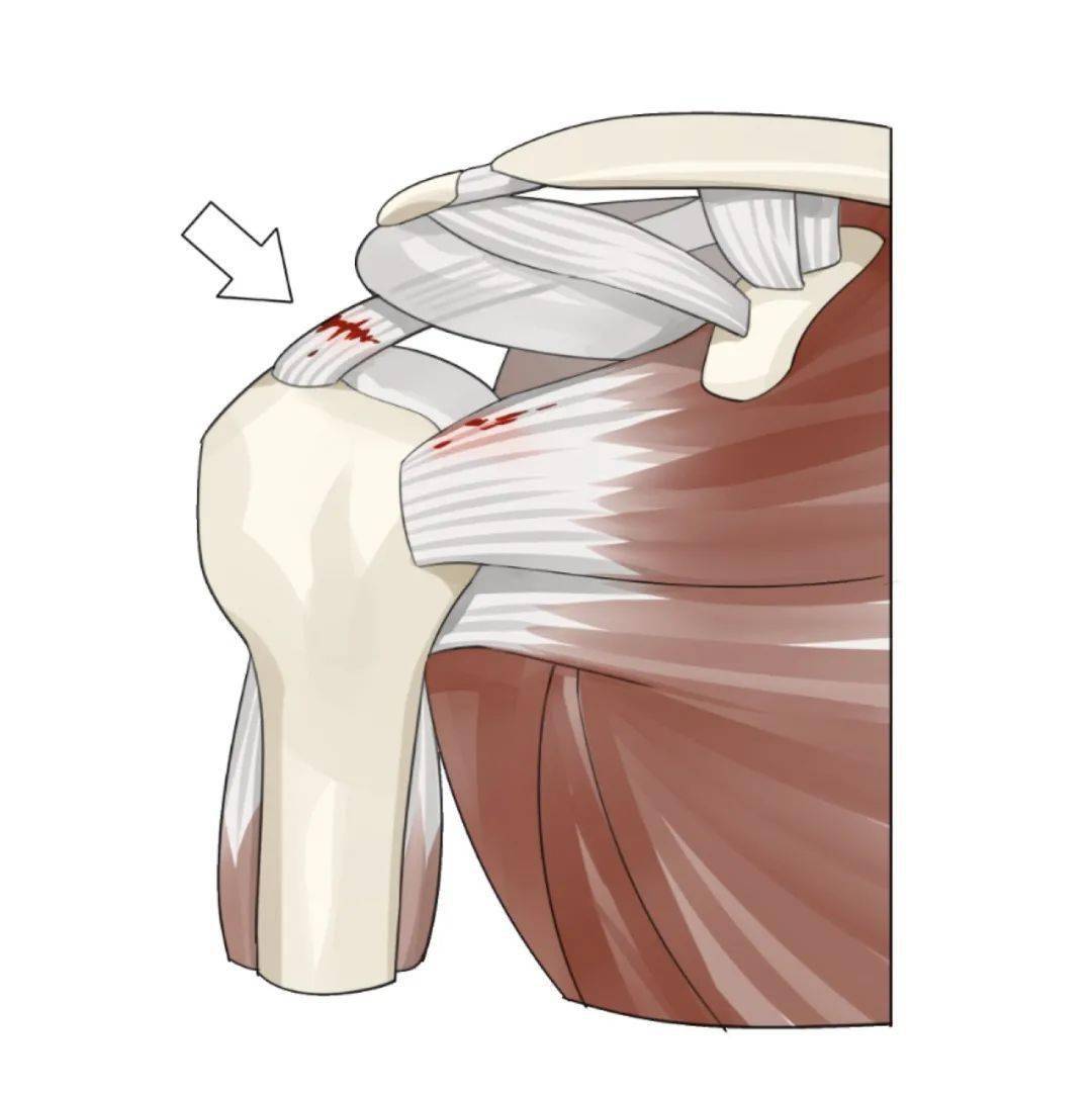 (肩关节的肩袖撕裂)肩袖由四根肌腱组成,每根肌腱损伤都会带来不同的