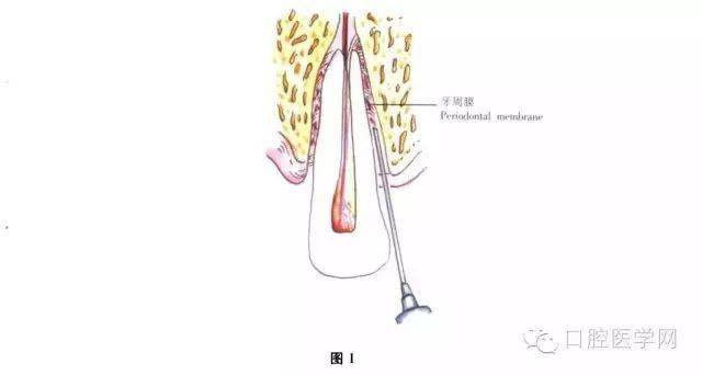 乳牙麻醉方法和图片图片