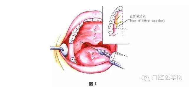 口腔颌面外科常用麻醉方法图谱