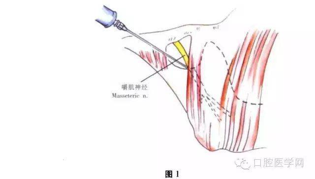 进针点:在下颌第二双尖牙根尖颊沟移行皱襞处.2.