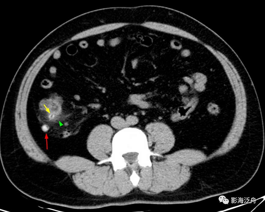 阑尾根部(黄箭)稍增粗,壁厚而强化,近端管腔内见高密度粪石影,注意