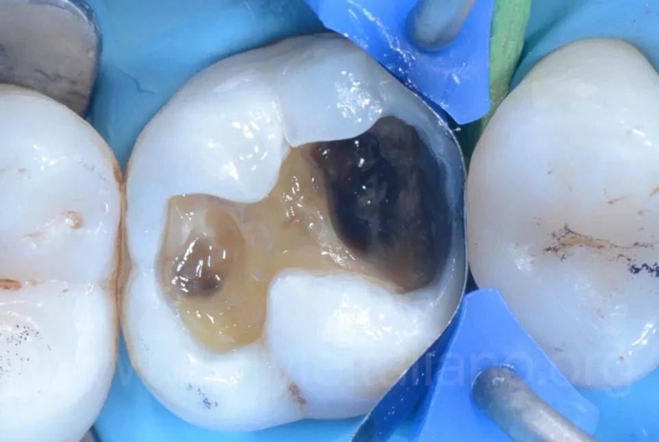 【牙医学堂】后牙邻面吻合龋的直接修复_咬合