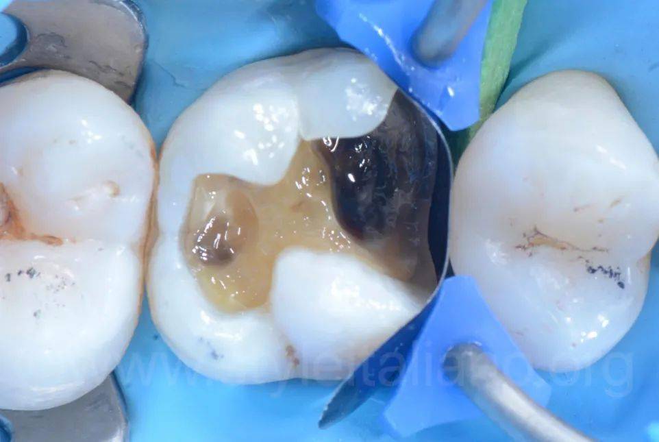 【牙医学堂】后牙邻面吻合龋的直接修复_咬合