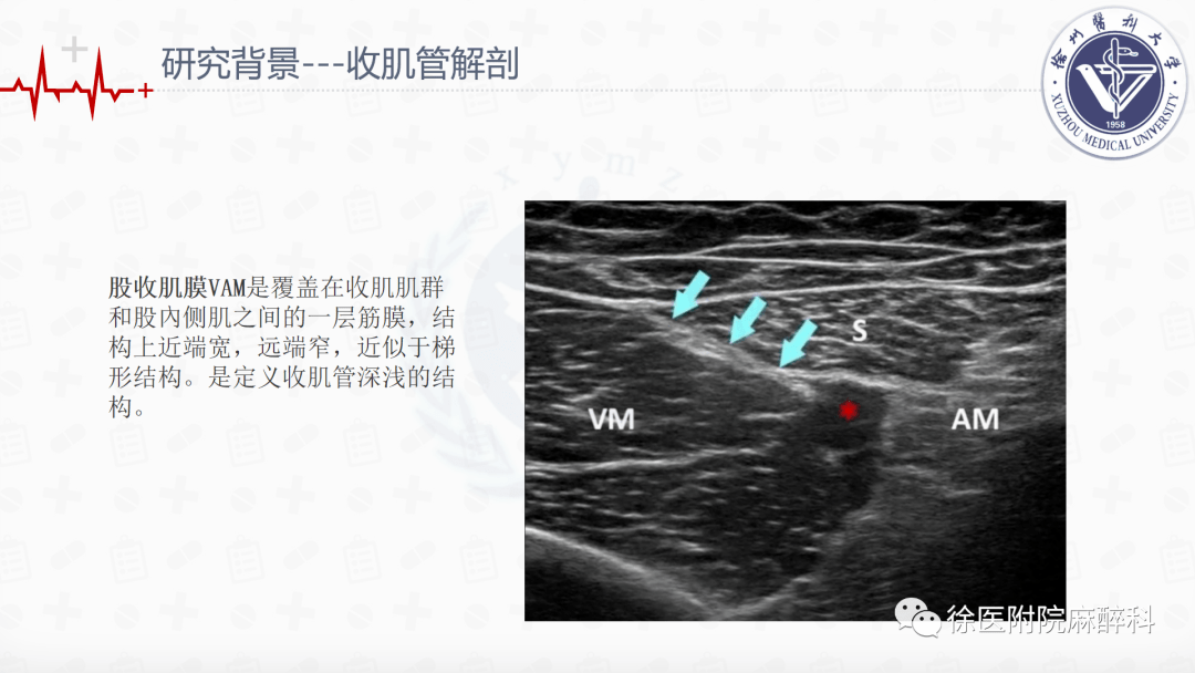 全膝关节置换术中局部浸润麻醉和连续收肌管阻滞结合ipack神经阻滞的