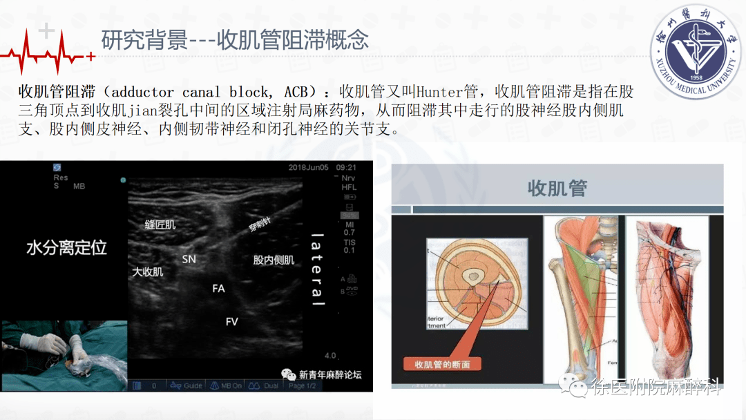 全膝关节置换术中局部浸润麻醉和连续收肌管阻滞结合ipack神经阻滞的