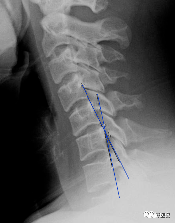 颈椎第五节滑脱图片图片