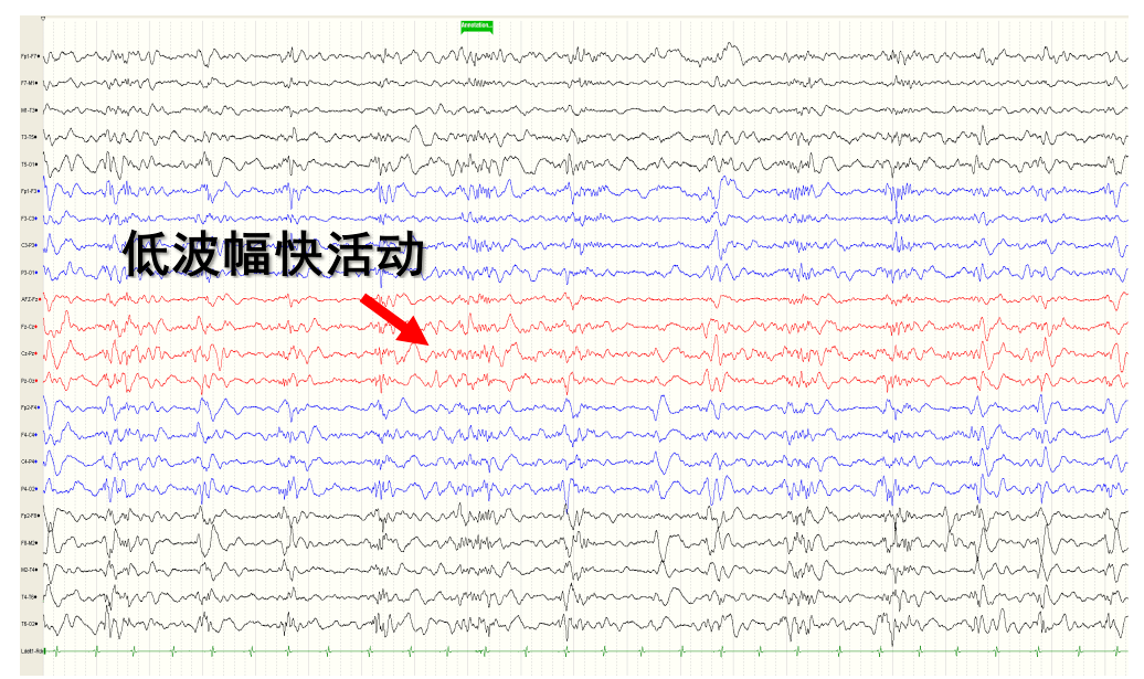 疯牛病的三相波脑电图图片