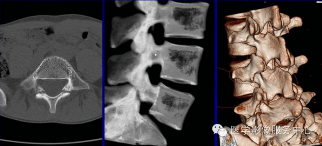 椎弓峡部裂ct诊断图片图片