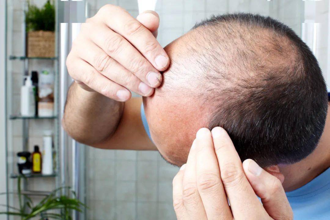 林乔|为工作熬秃了头,赚的钱却连植发都不够?