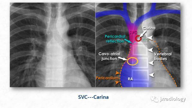 picc尖端的胸片定位