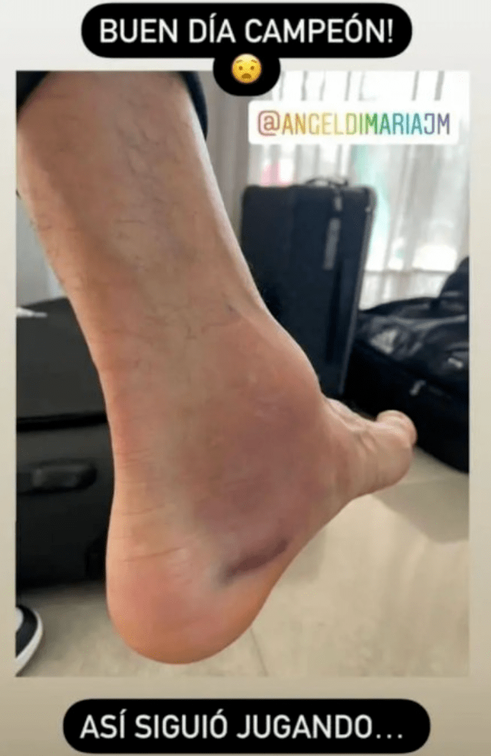 妻子晒迪马利亚脚踝:他就是这样肿着坚持比赛的