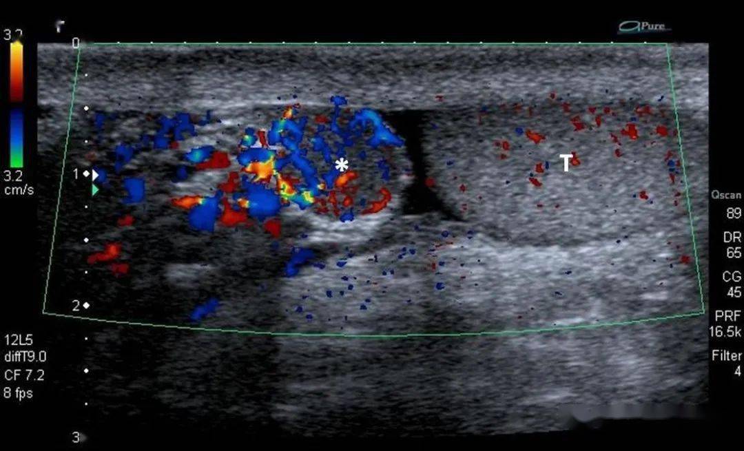 超声解剖61副脾