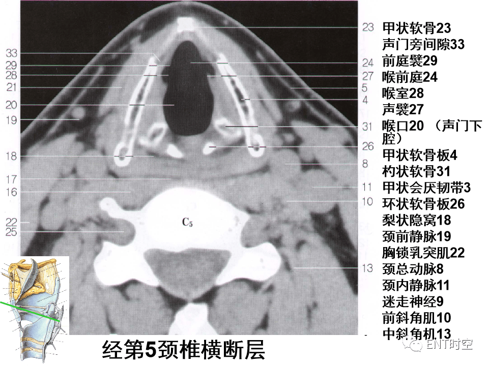 甲状软骨解剖图ct图片