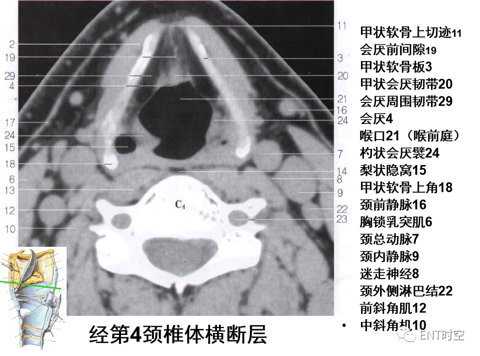 甲状软骨解剖图ct图片