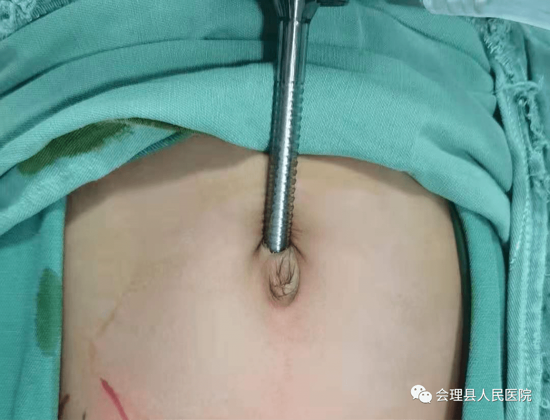 单孔腹腔镜切口图片