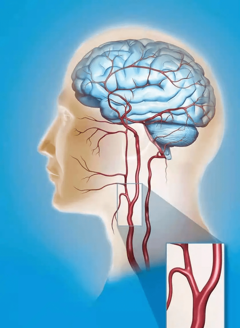 脑卒中多半由这种病因导致夏季尤其需要做好预防