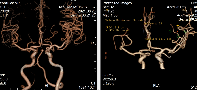 術後第二日複查頭顱ct:左側額顳頂葉片狀梗死術後即刻複查頭顱ct取