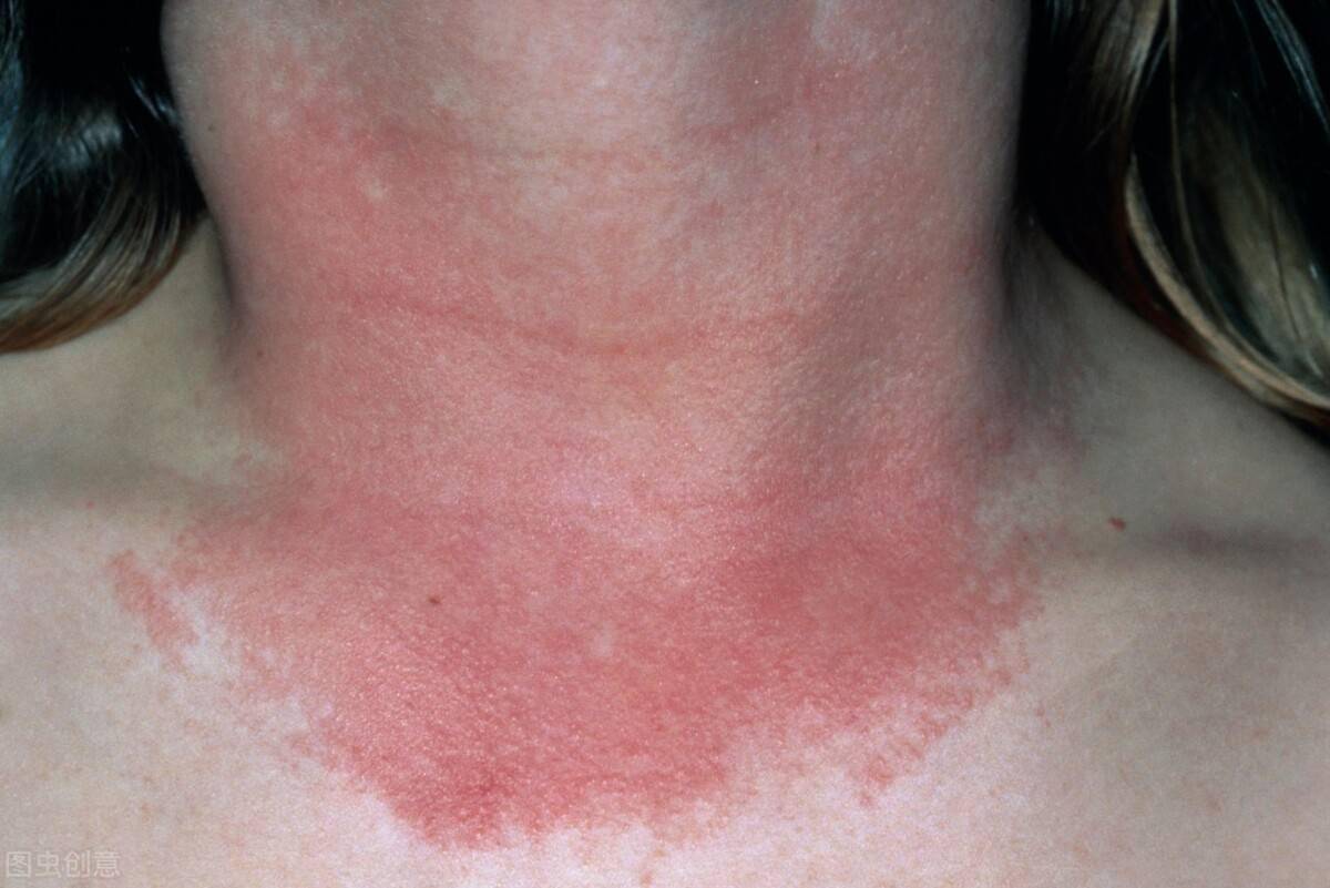 吃药也需要躲太阳这些药会产生光敏反应吃了后千万别晒太阳