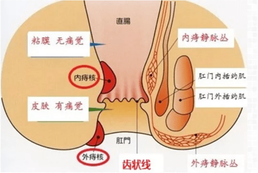 放疗后痔疮疼怎么办