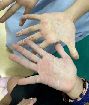 在等待松节油的过程中,他先用棉签从掌心空隙处开始,慢慢转动棉签,一