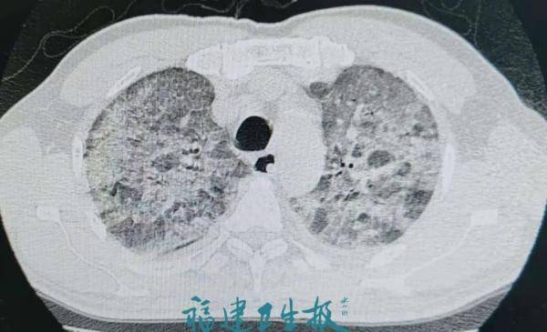 虫子|福州男子莫名发热咳嗽，竟是因这虫子…