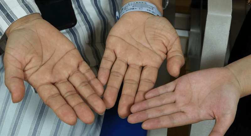 蓝红|鼻变大、唇变厚、面相变粗犷，这些信号都是脑内长了良性瘤