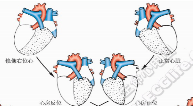 我院心血管内二科成功为一"肝移植术后,右位心,急性心肌梗死"罕见患者