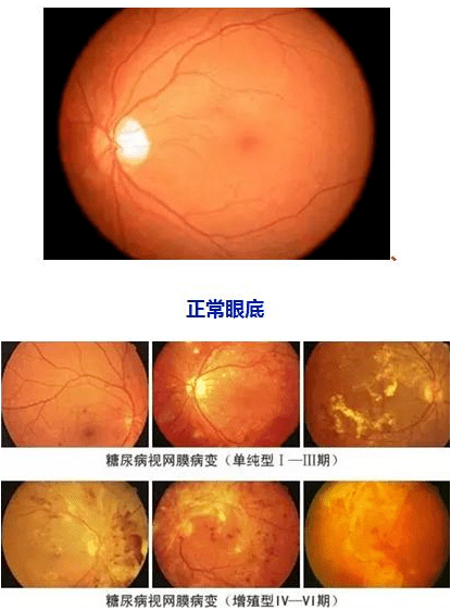 病视网膜病变是眼底病变进展快速,随病变进展,视力损害加重,直至失明