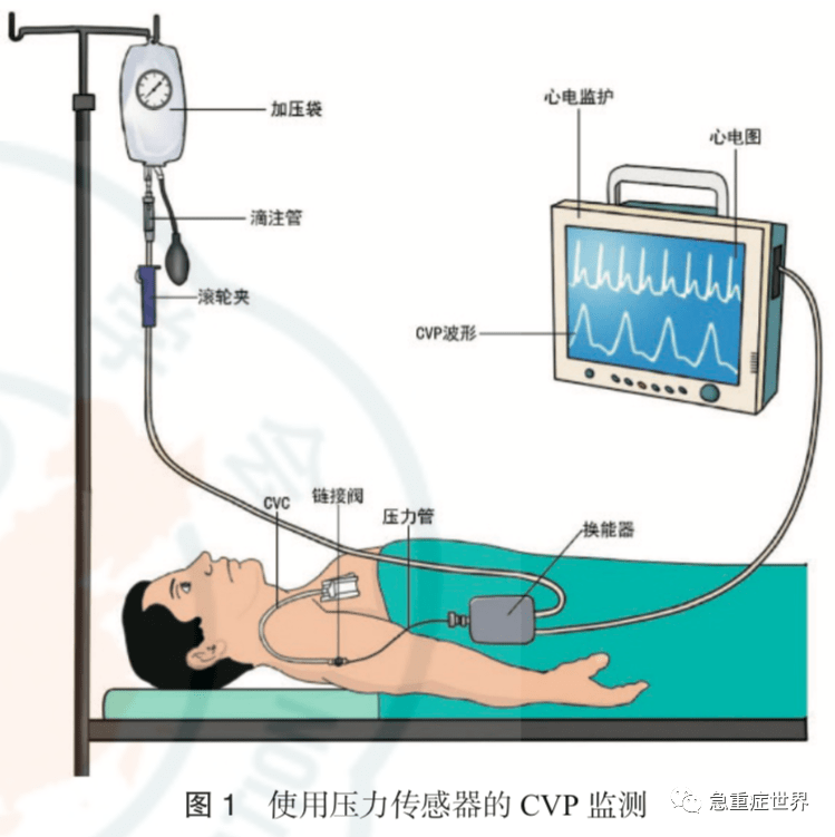 cvp監測是以特定患者的特定問題為導向,對了解有效循環血容量和心功能