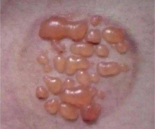 艾灸"烫"出的水泡有学问