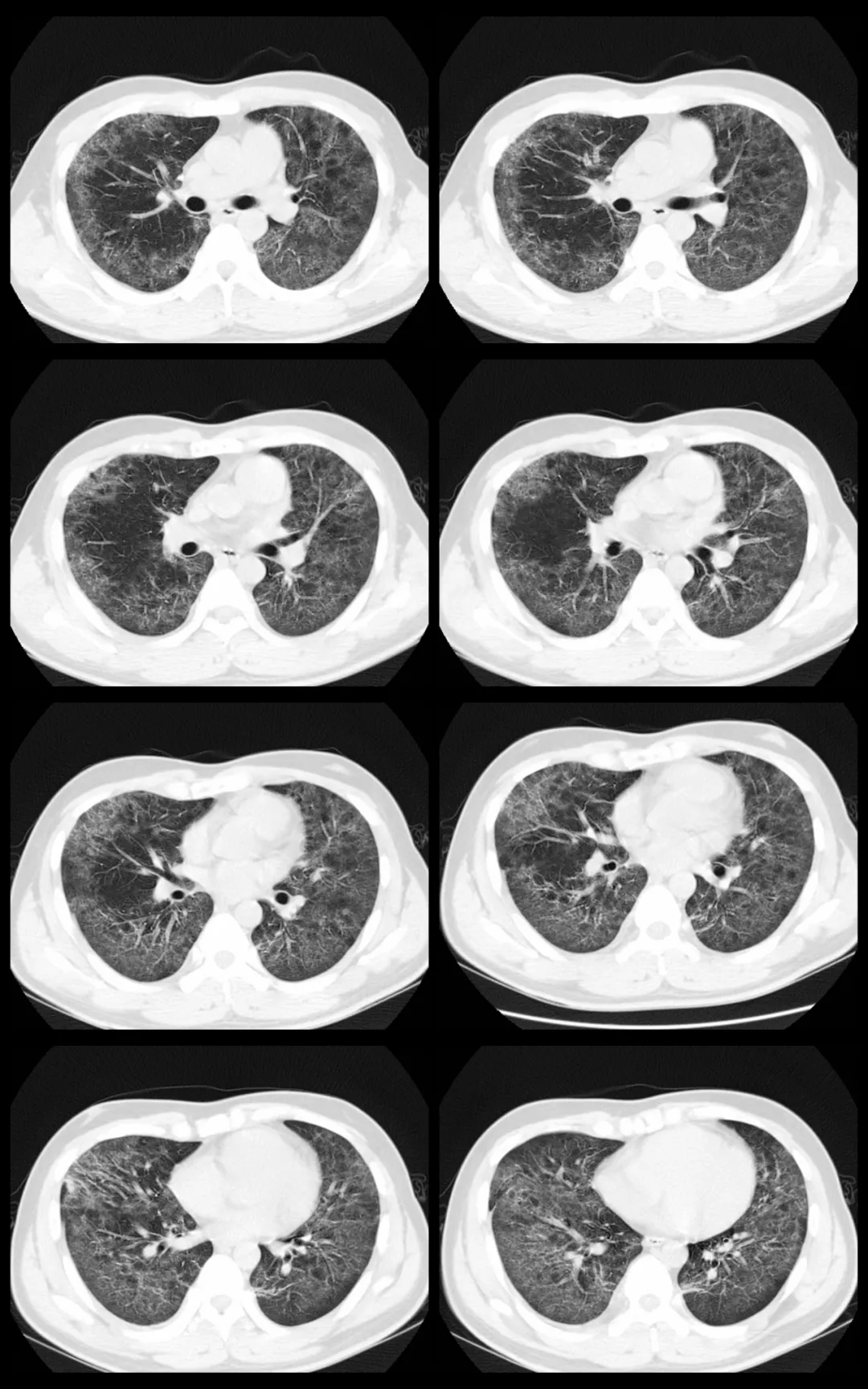 肺部ct磨玻璃影图片图片