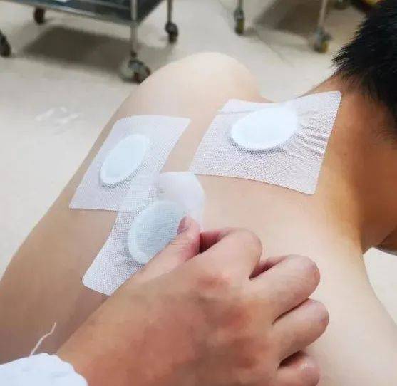 穴位|注意！三伏膏这么贴易受伤！69岁女子后背红肿，走路都痛