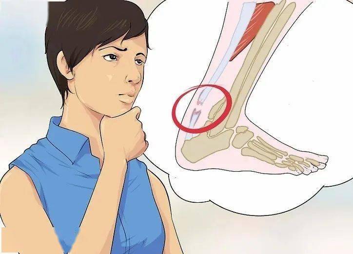 小腿肌肉拉伤不要怕,及时处理助您快速康复_损伤